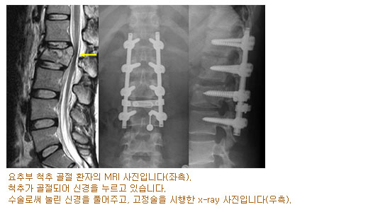 ߺ ô  ȯ MRI Դϴ.(). ô߰ Ǿ Ű  ֽϴ. ν  Ű Ǯְ   x-ray Դϴ.()